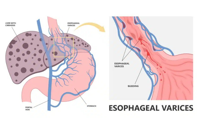 Esophageal Variceal Band Ligation