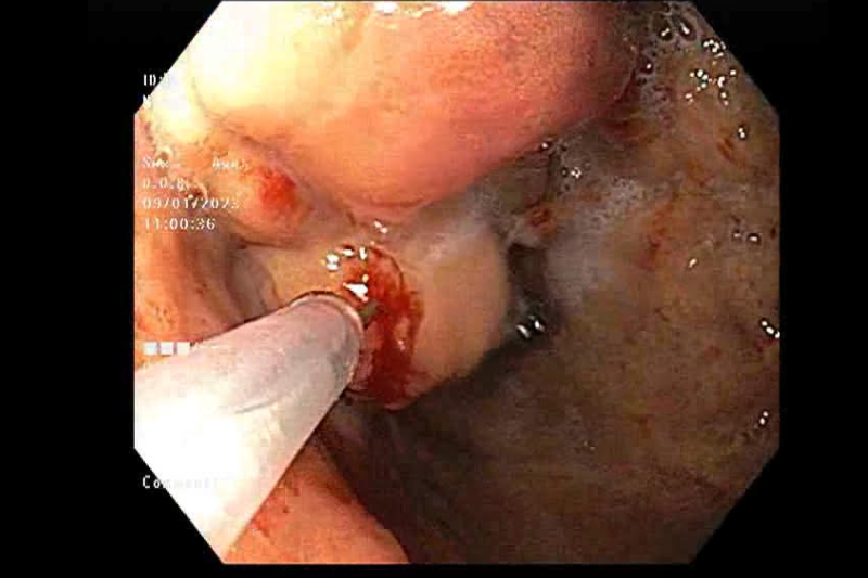 Fundal Variceal Glue Injection