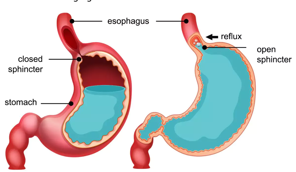 Gerd Treatment In Nanded