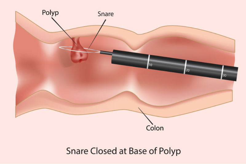 Polypectomy