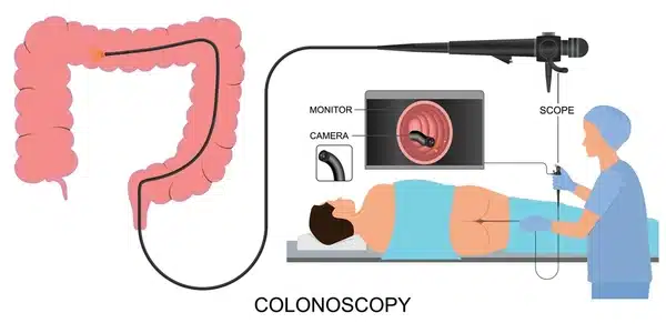 colonoscopy in nanded
